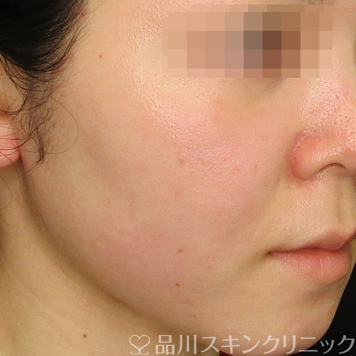 症例NO.75111のBEFORE写真