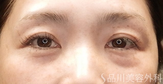 症例NO.74745のBEFORE写真