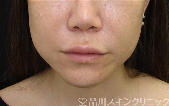 症例NO.58650のBEFORE写真