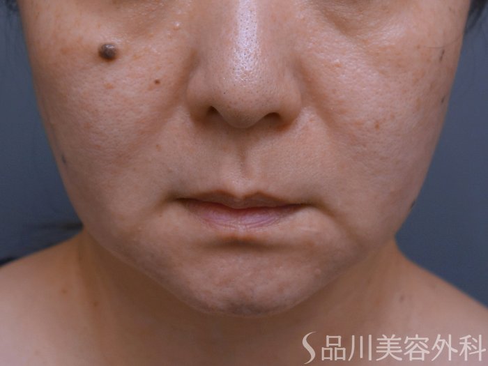 症例NO.74301のBEFORE写真