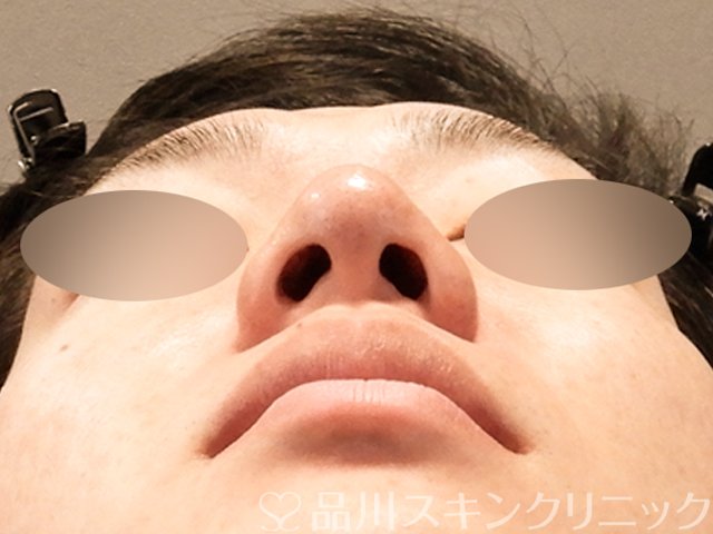 症例NO.70282のBEFORE写真