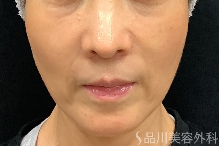 症例NO.71248のBEFORE写真