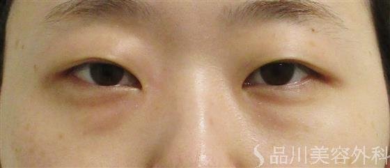 症例NO.55934のBEFORE写真