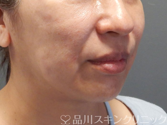 症例NO.70602のAFTER写真