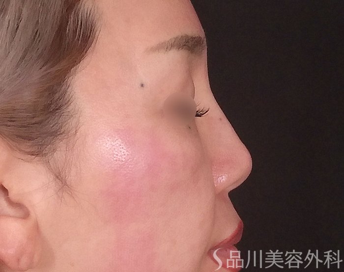 症例NO.69217のBEFORE写真