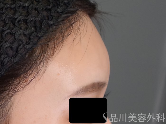 症例NO.69225のBEFORE写真