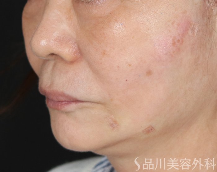 症例NO.71470のAFTER写真