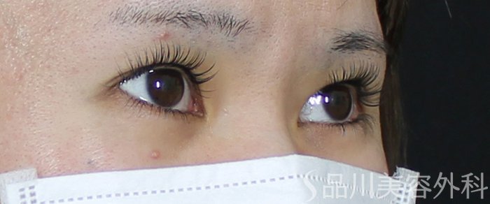 症例NO.72114のBEFORE写真