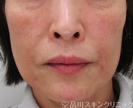 症例NO.33713のAFTER写真