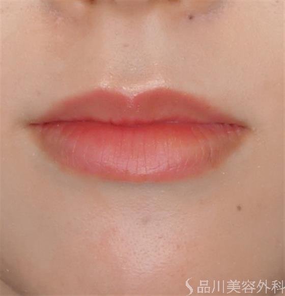 症例NO.53868のBEFORE写真