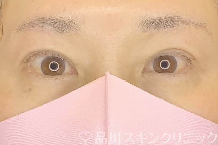症例NO.65265のAFTER写真