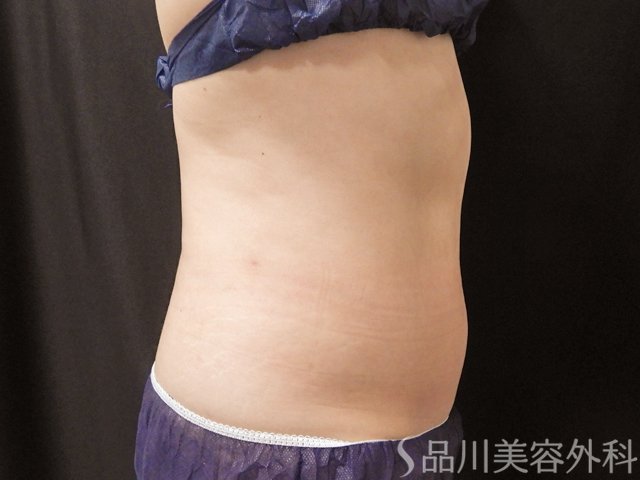 症例NO.74541のBEFORE写真