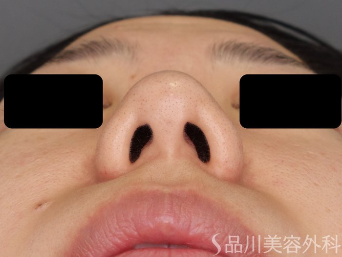 症例NO.72263のBEFORE写真