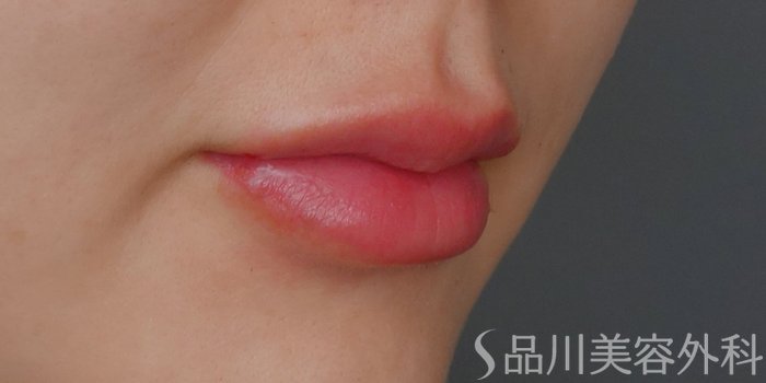 症例NO.71763のAFTER写真