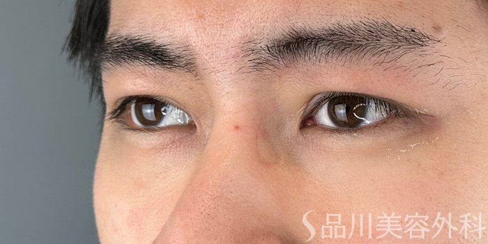 症例NO.69284のAFTER写真