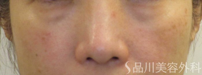 症例NO.71068のBEFORE写真