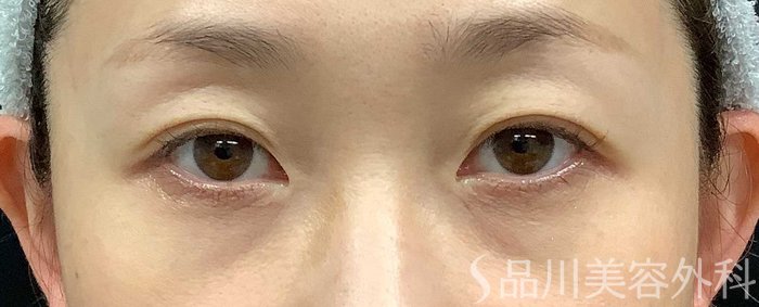 症例NO.71034のBEFORE写真