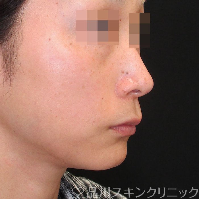 症例NO.75143のAFTER写真