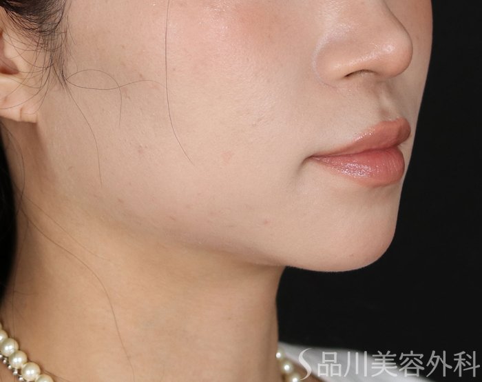 症例NO.72185のAFTER写真