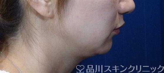 症例NO.32771のBEFORE写真