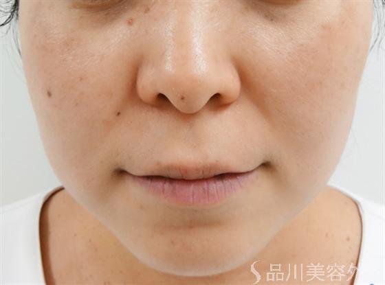 症例NO.14547のAFTER写真