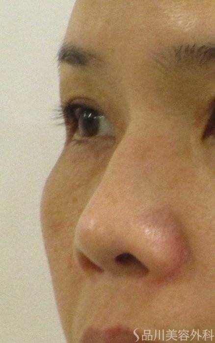 症例NO.69302のBEFORE写真