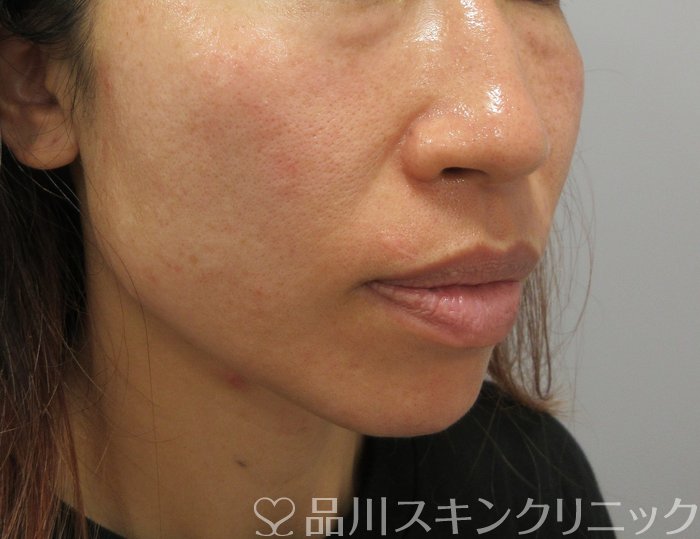 症例NO.74033のBEFORE写真