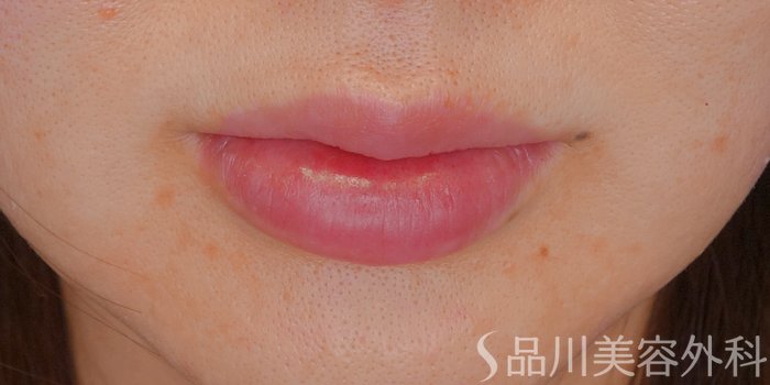 症例NO.72337のAFTER写真