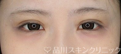 症例NO.65410のAFTER写真