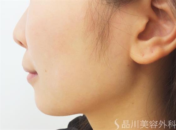 症例NO.31944のBEFORE写真