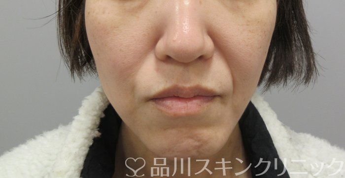 症例NO.69837のBEFORE写真