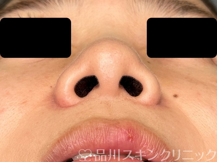 症例NO.62984のBEFORE写真