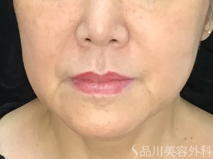 症例NO.71596のBEFORE写真