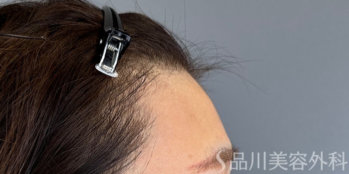 症例NO.73139のAFTER写真