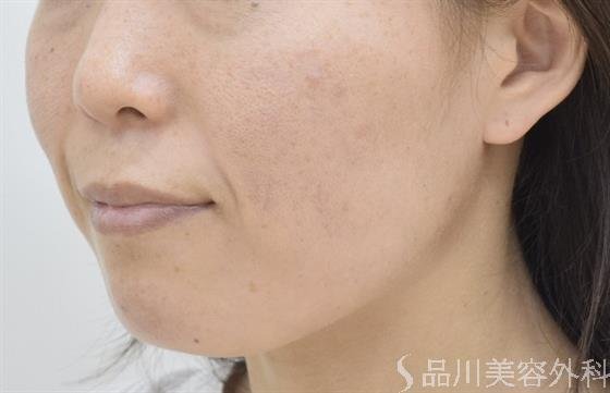 症例NO.42609のBEFORE写真