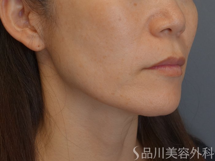 症例NO.72196のBEFORE写真