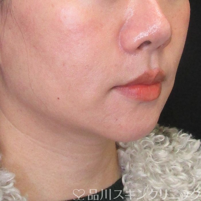 症例NO.73941のBEFORE写真