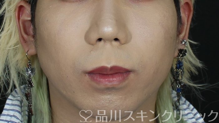 症例NO.71093のBEFORE写真