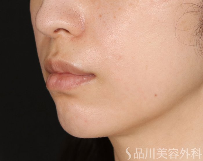 症例NO.71303のBEFORE写真