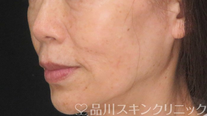 症例NO.71010のBEFORE写真