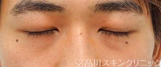 症例NO.49217のBEFORE写真