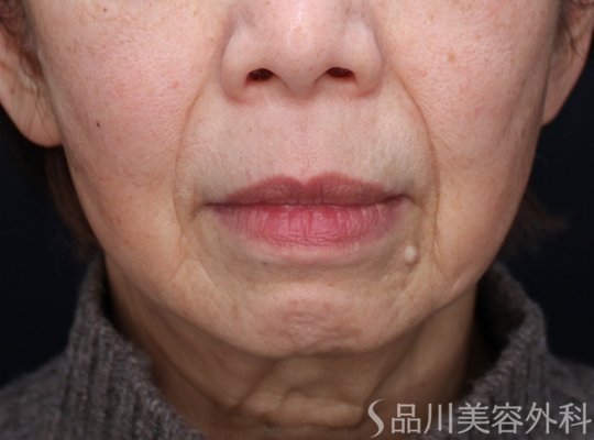 症例NO.73294のBEFORE写真