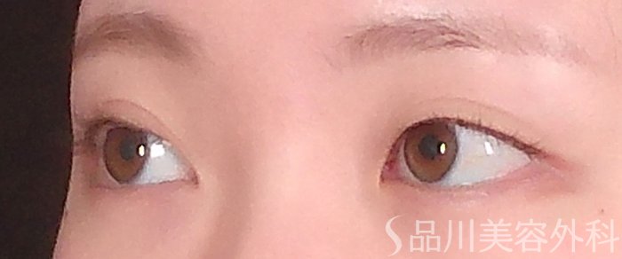 症例NO.70990のBEFORE写真