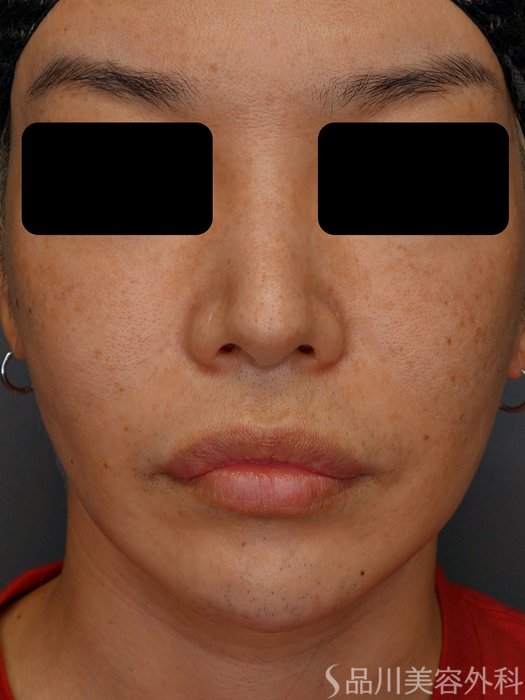 症例NO.73158のBEFORE写真