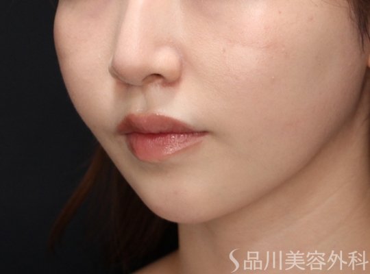 症例NO.71825のAFTER写真
