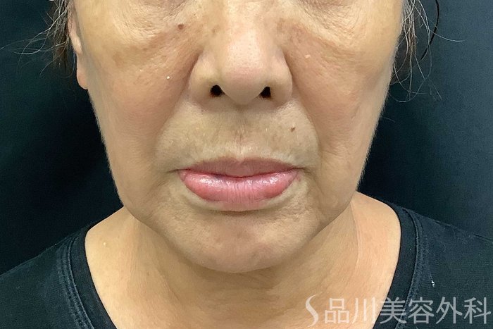 症例NO.69776のBEFORE写真