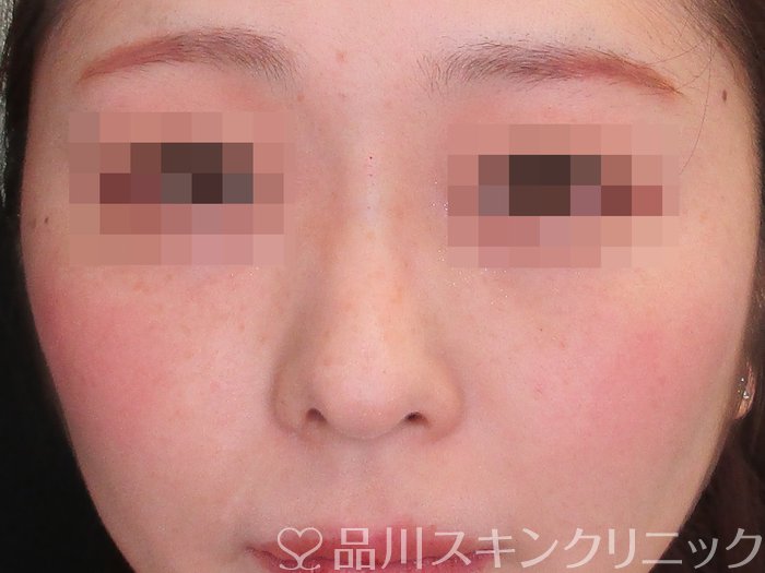 症例NO.74077のAFTER写真