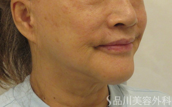 症例NO.71661のBEFORE写真