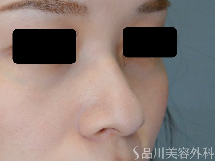 症例NO.71124のBEFORE写真