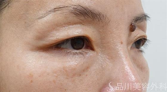 症例NO.50761のBEFORE写真